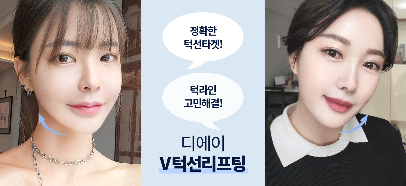 V턱선리프팅 후
