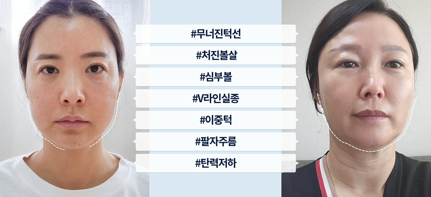 V턱선리프팅 전