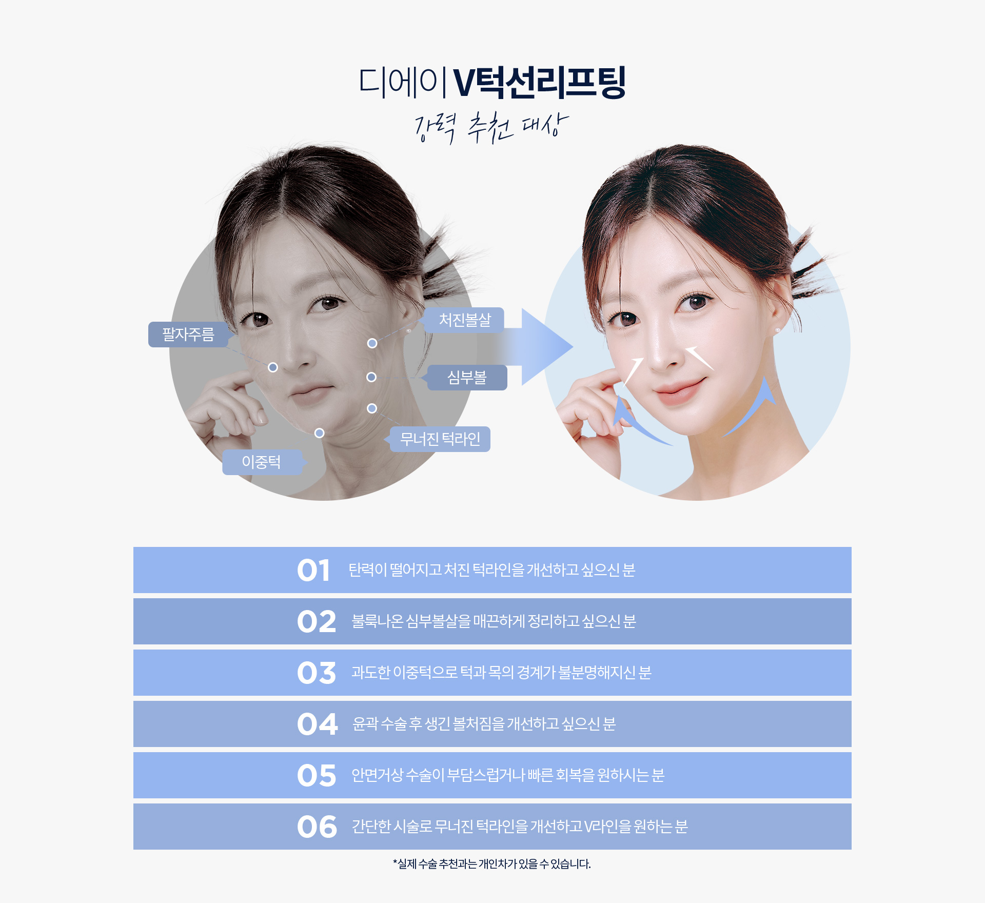 디에이 V턱선리프팅