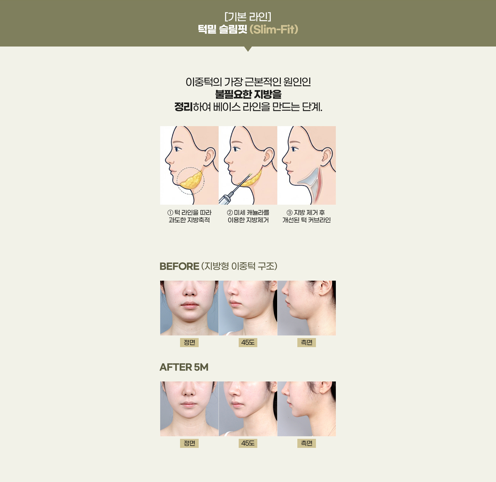 디에이 연조직 이중턱 근육묶기