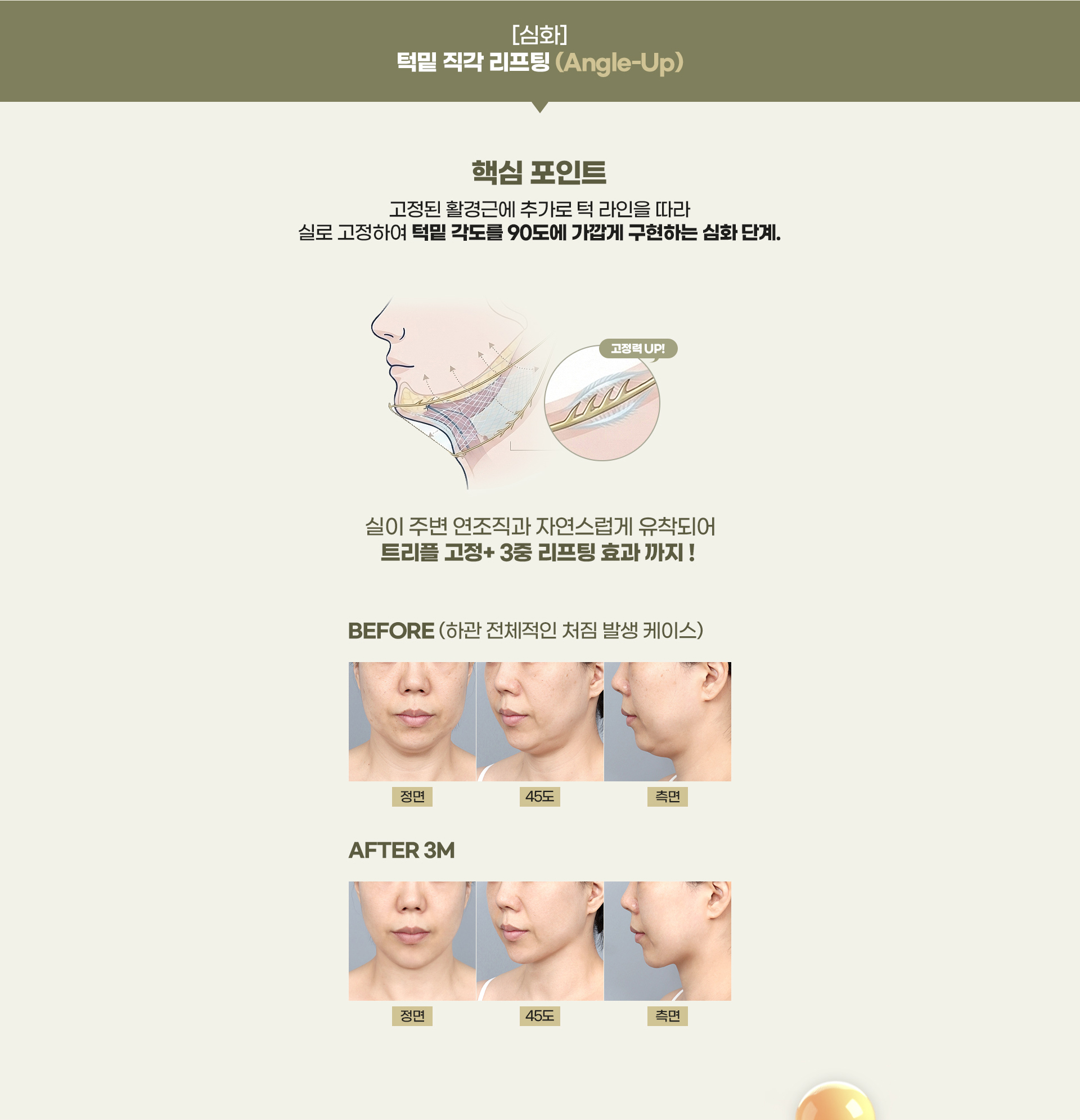 디에이 연조직 이중턱 근육묶기
