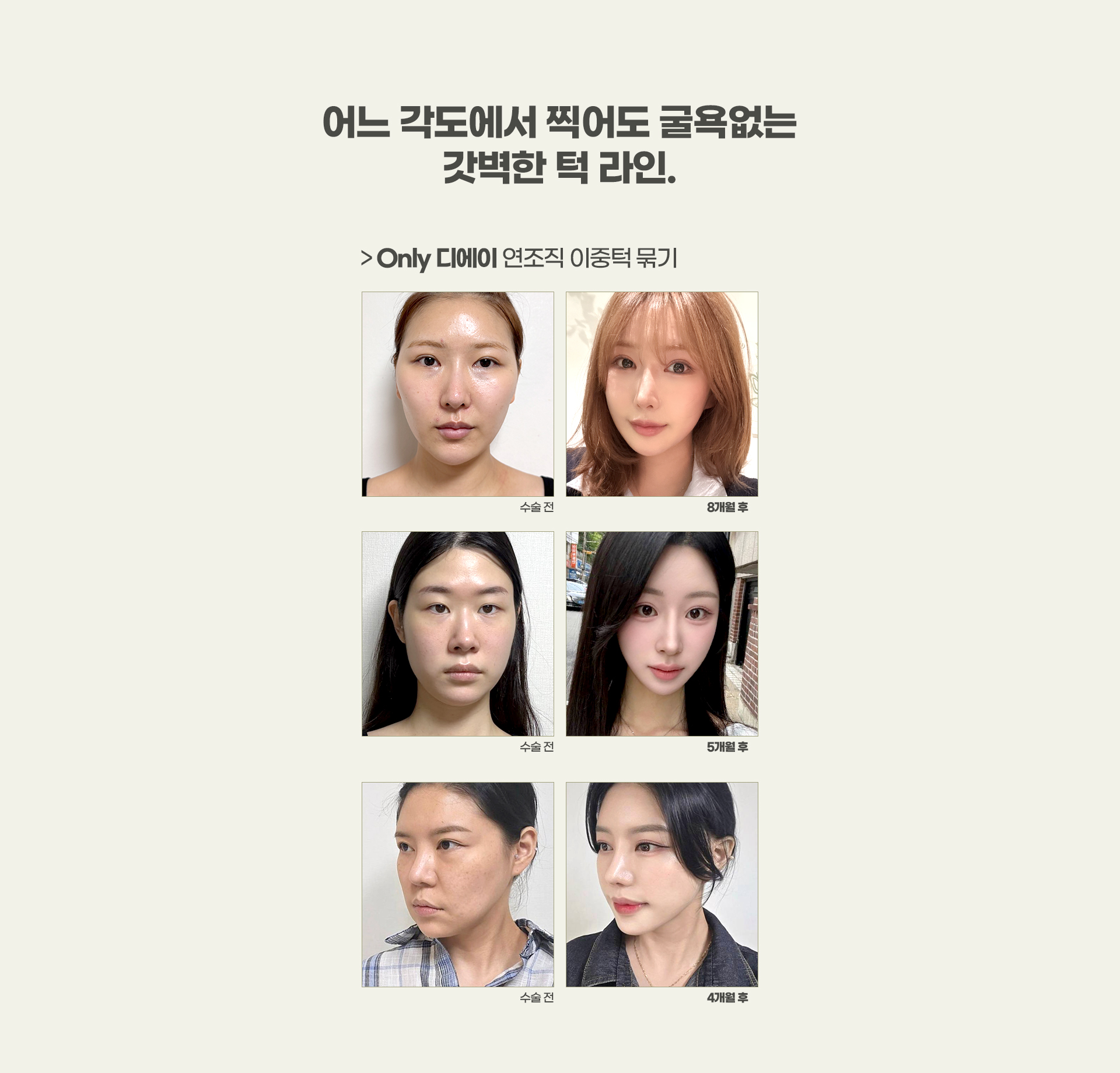 디에이 연조직 이중턱 근육묶기
