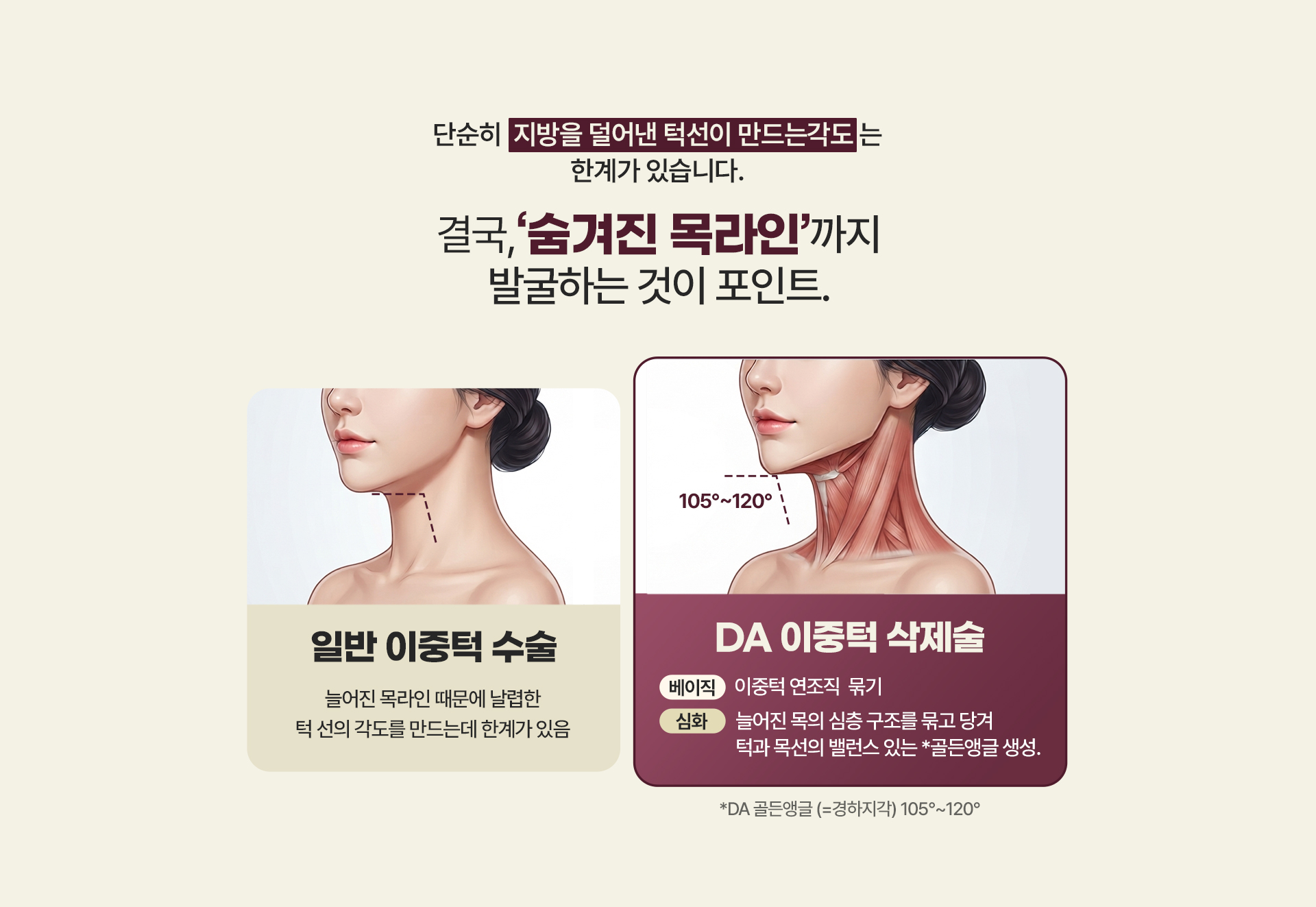 디에이 이중턱 삭제술