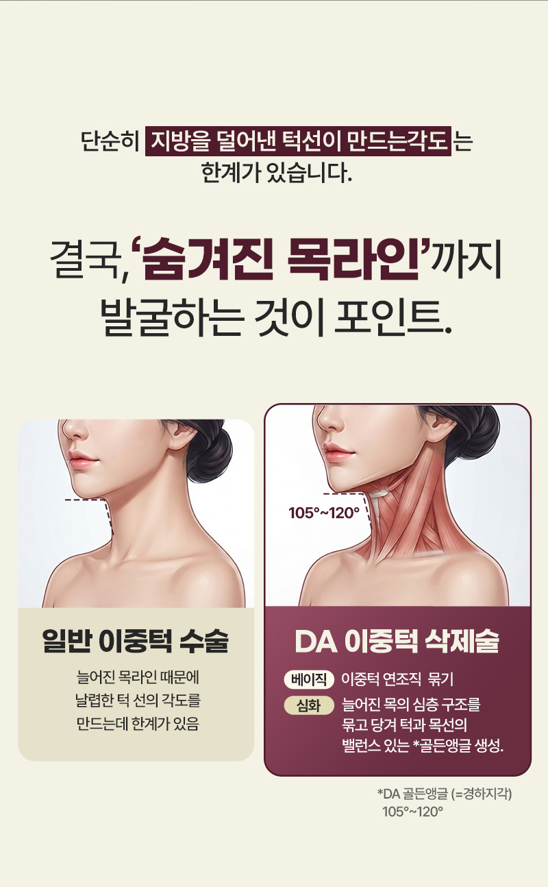 디에이 이중턱 삭제술