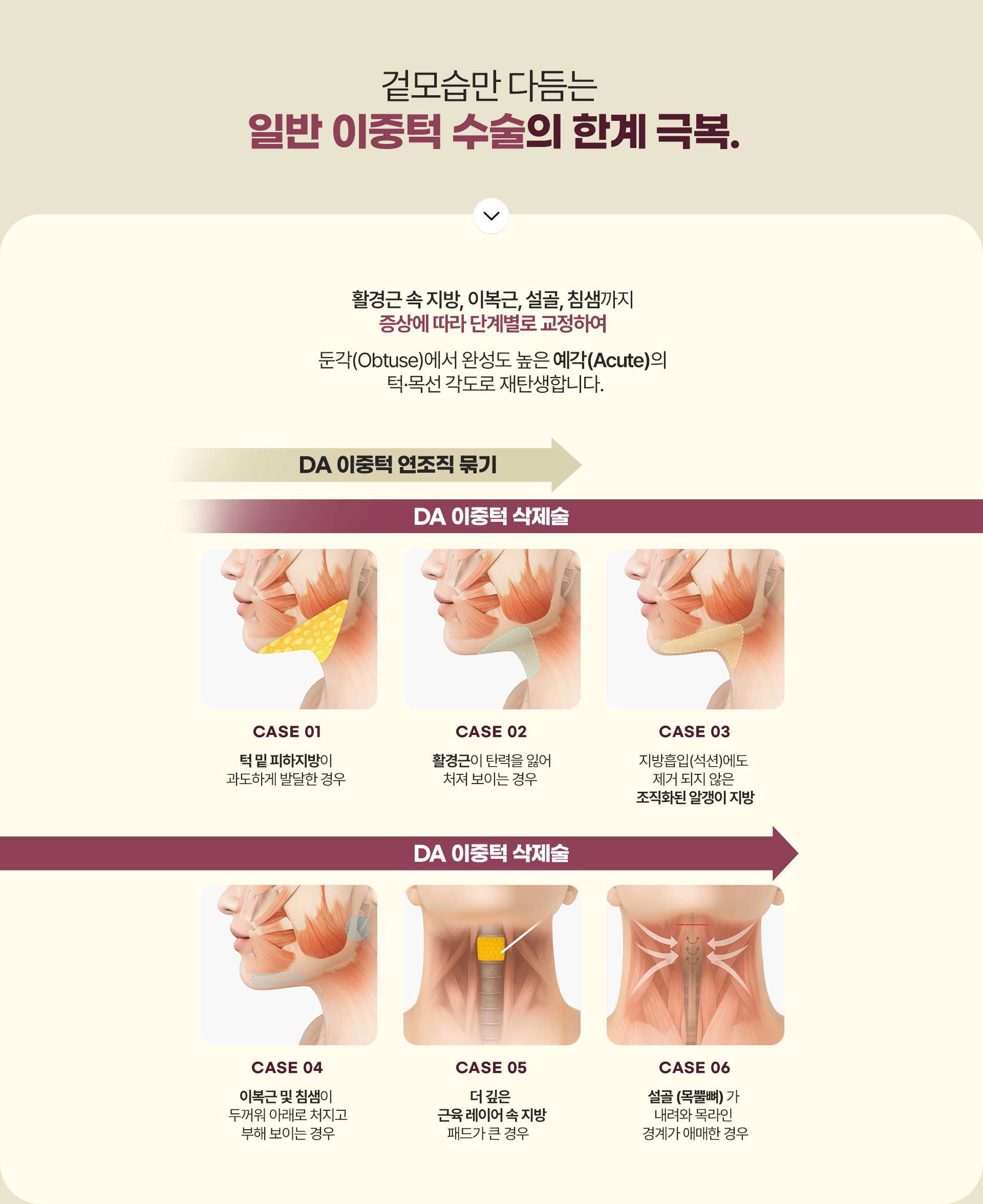 디에이 이중턱 삭제술