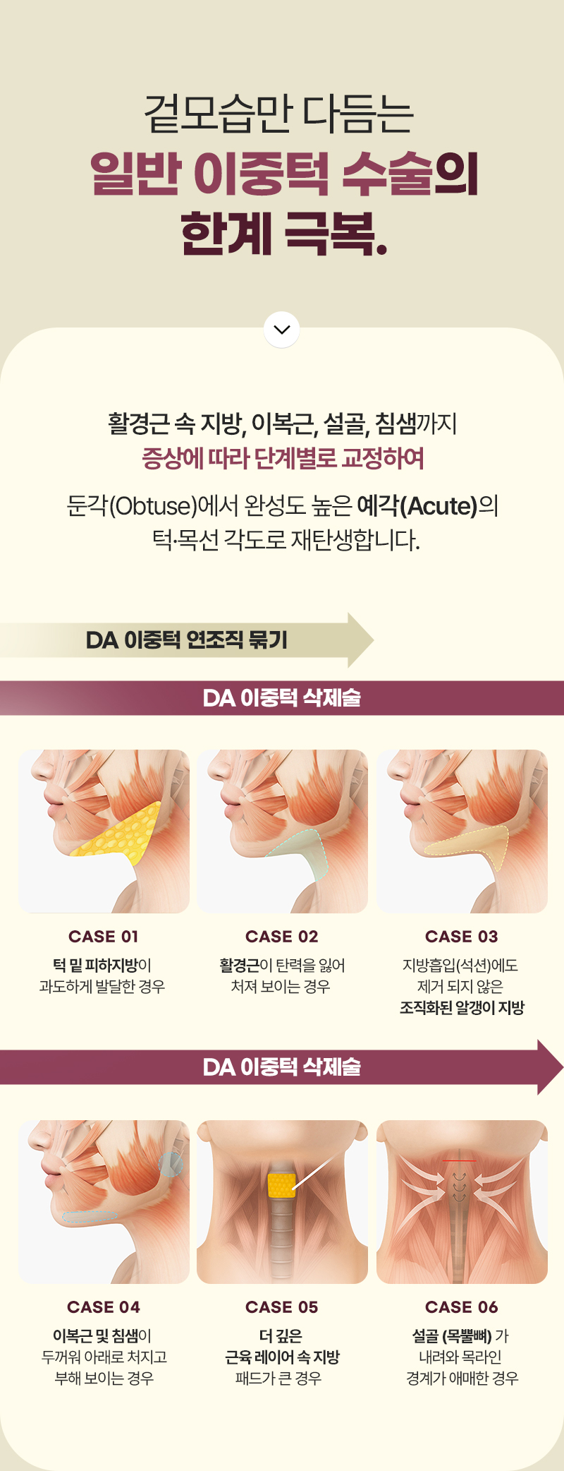 디에이 이중턱 삭제술