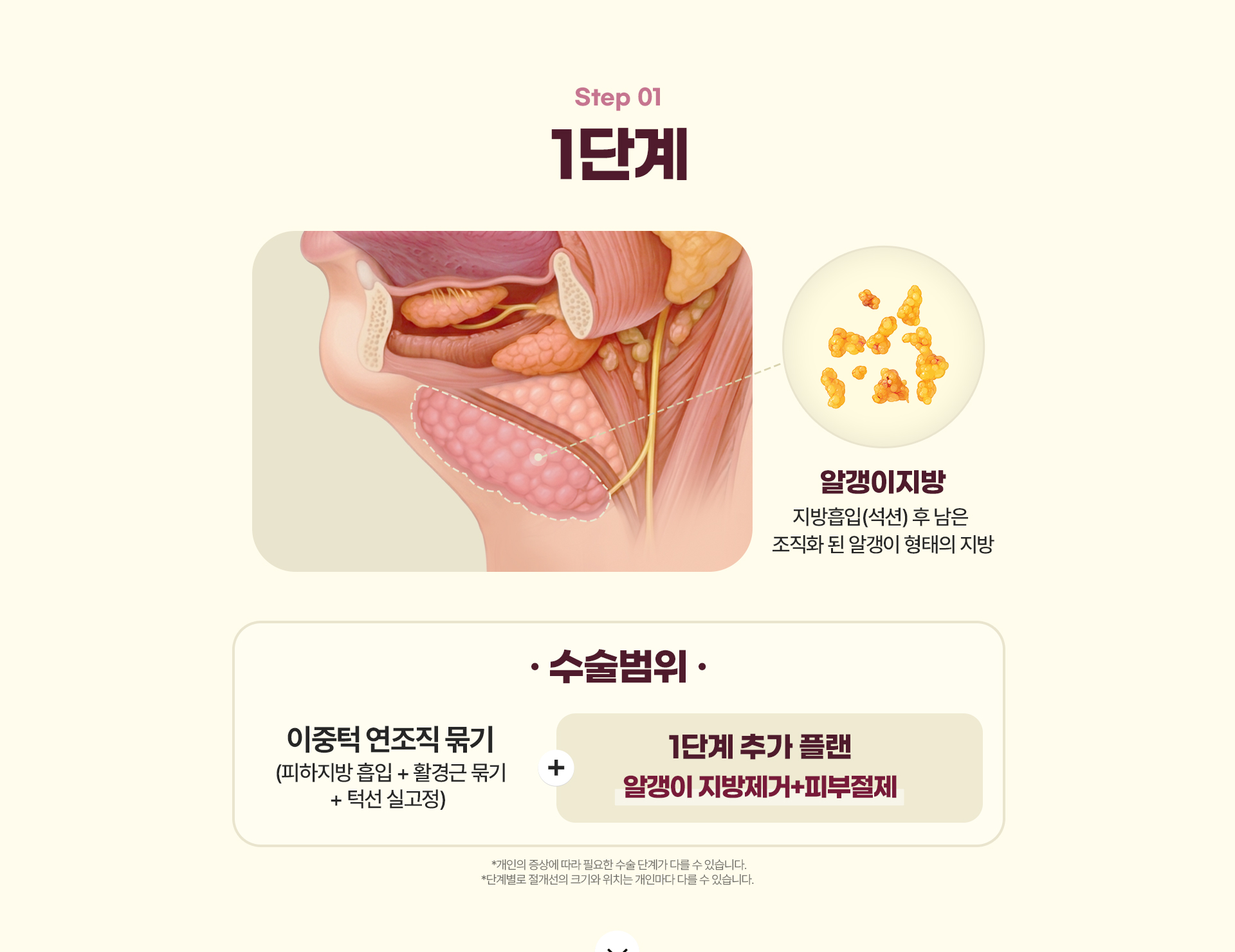 디에이 이중턱 삭제술