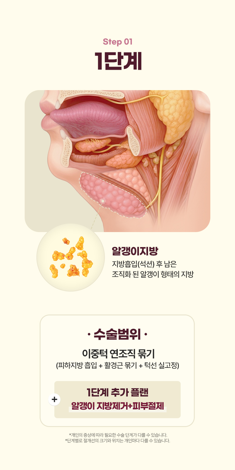디에이 이중턱 삭제술