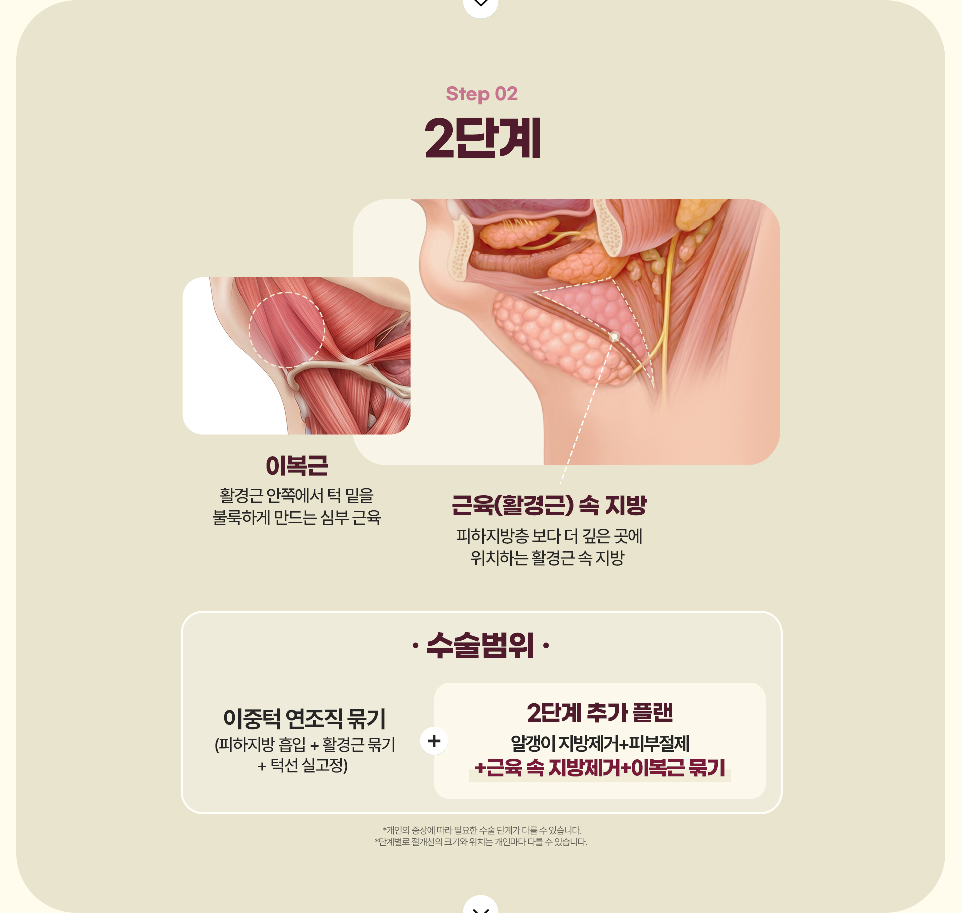 디에이 이중턱 삭제술