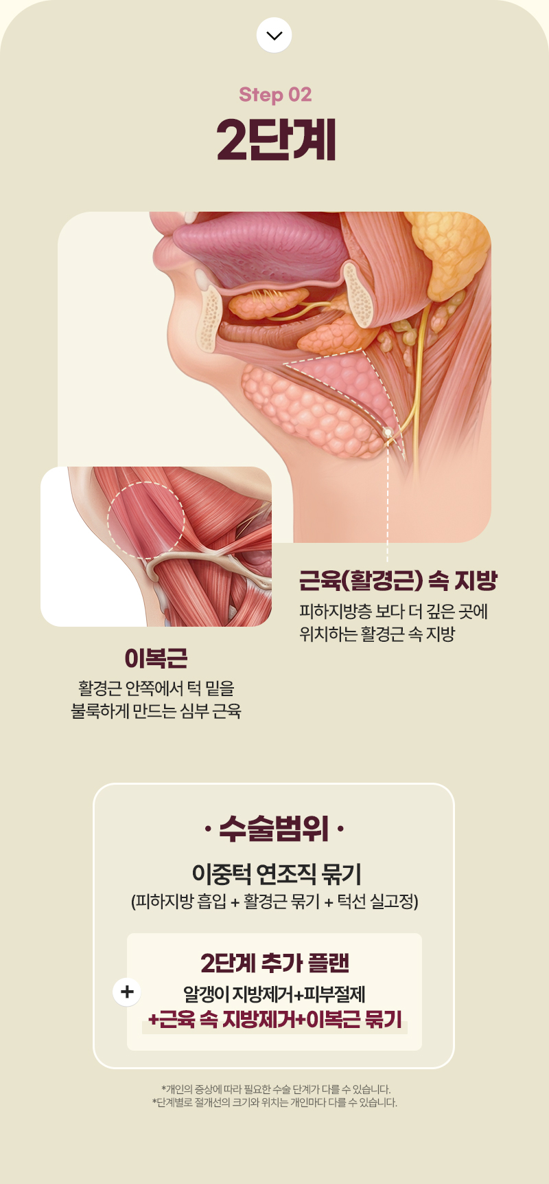 디에이 이중턱 삭제술