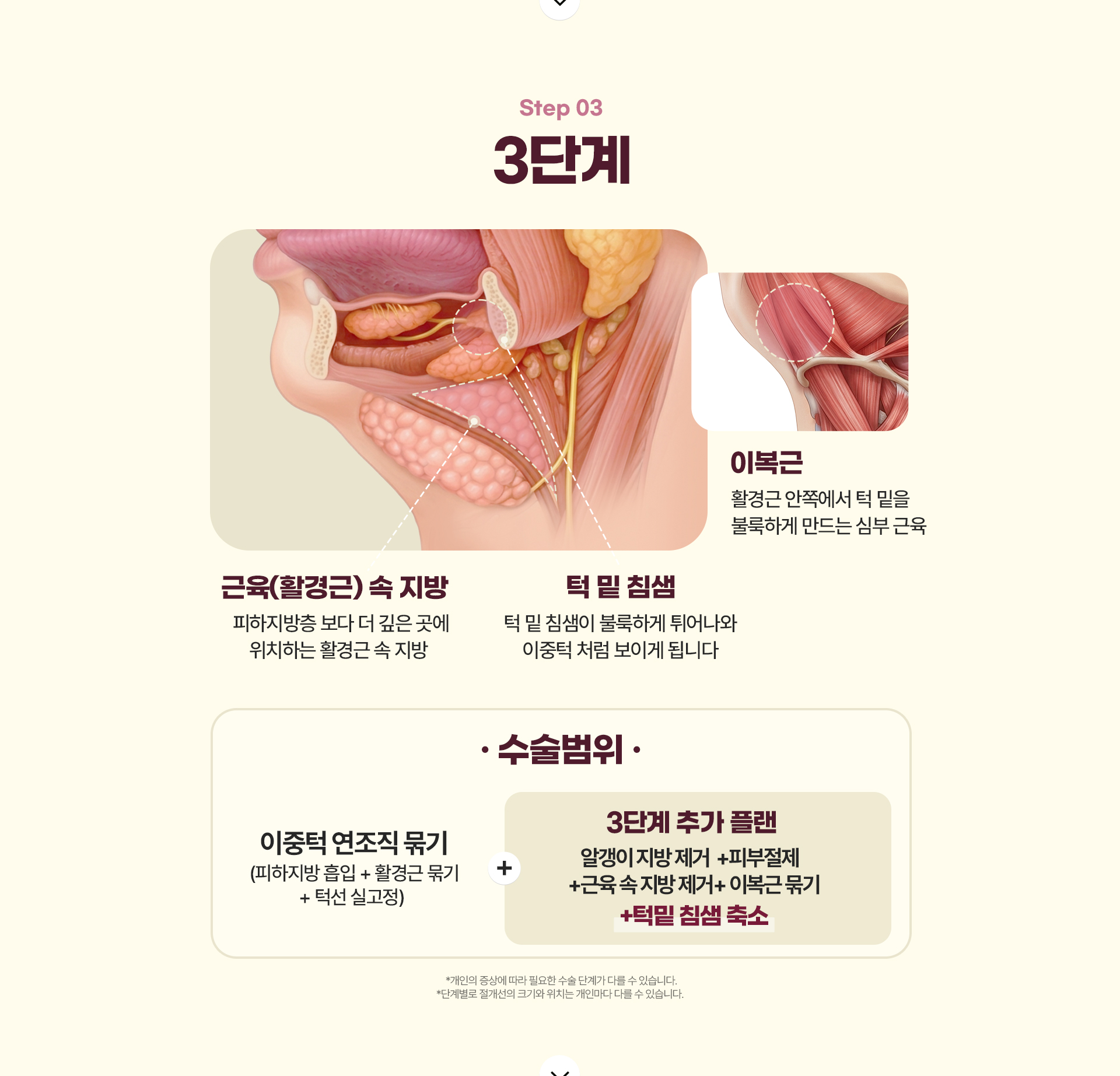 디에이 이중턱 삭제술