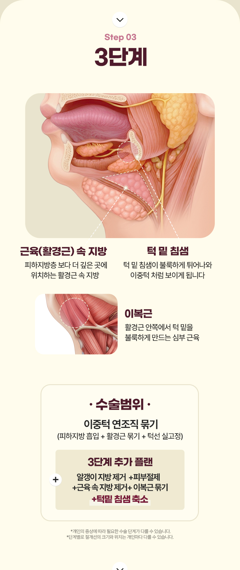 디에이 이중턱 삭제술
