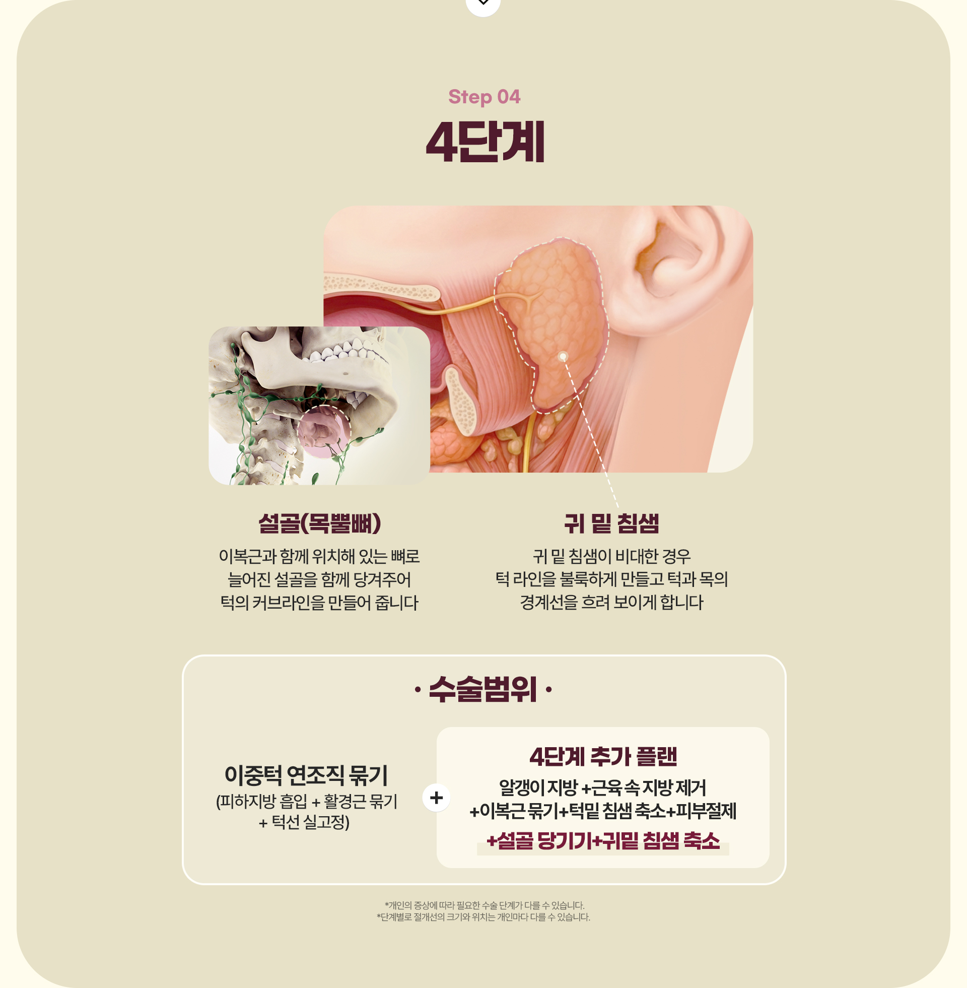 디에이 이중턱 삭제술