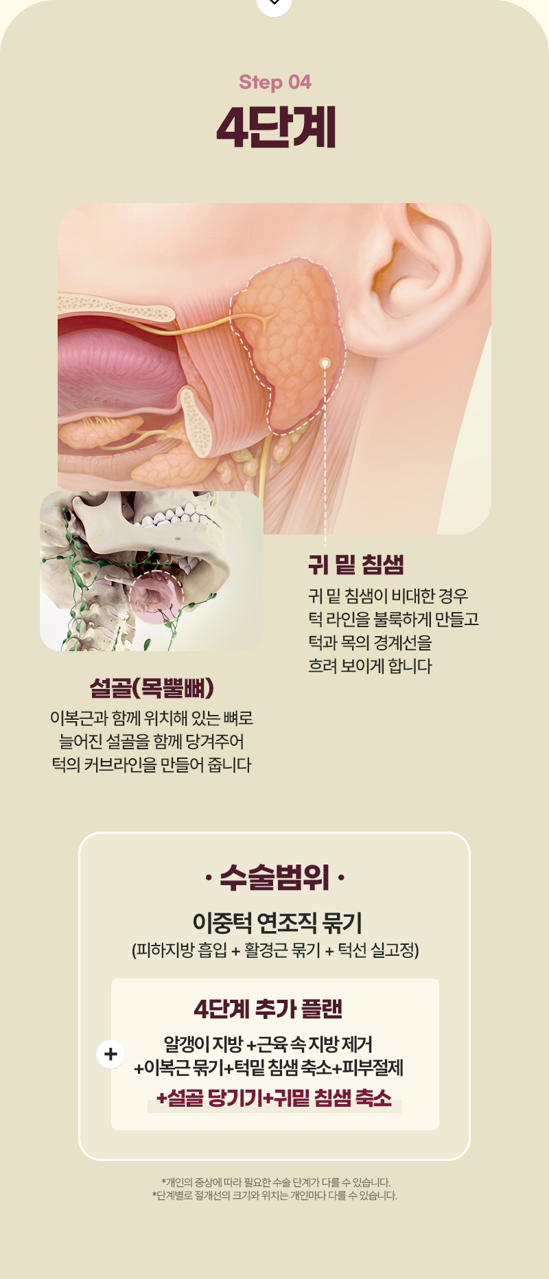 디에이 이중턱 삭제술