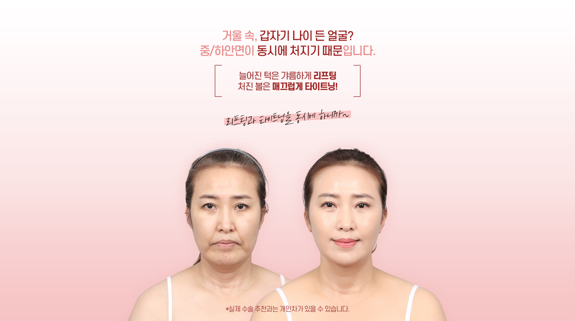 디에이 리프팅 풀미니리프팅