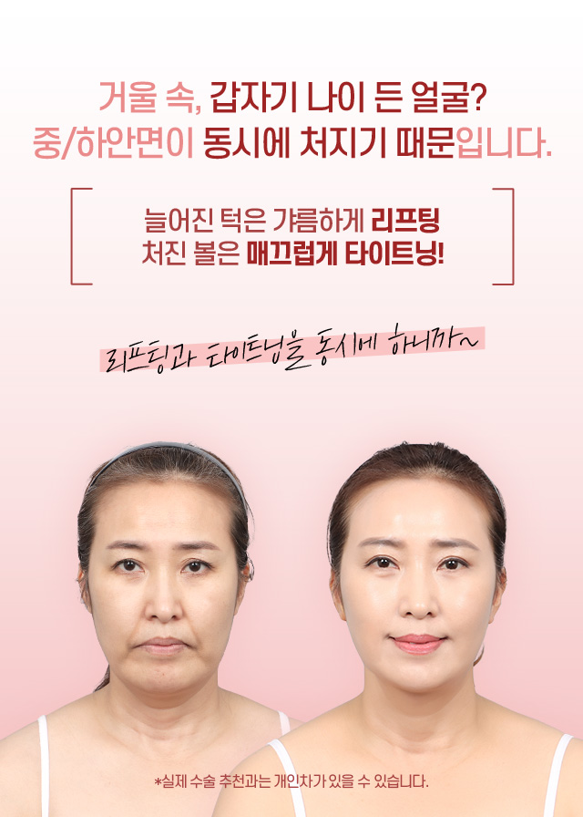디에이 리프팅 풀미니리프팅