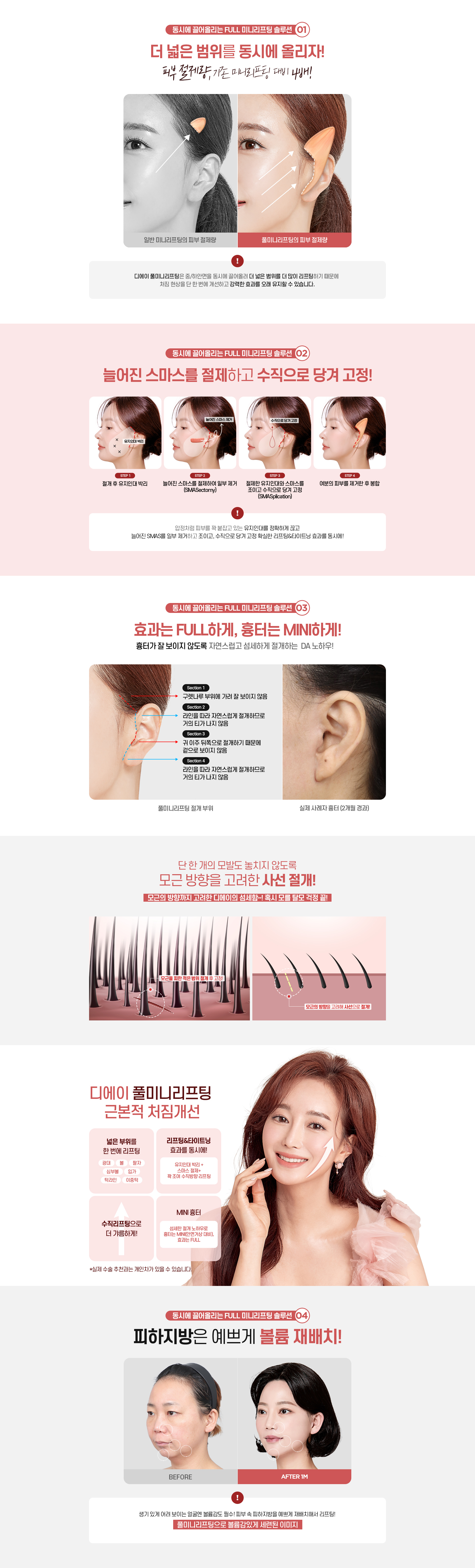디에이 리프팅 풀미니리프팅