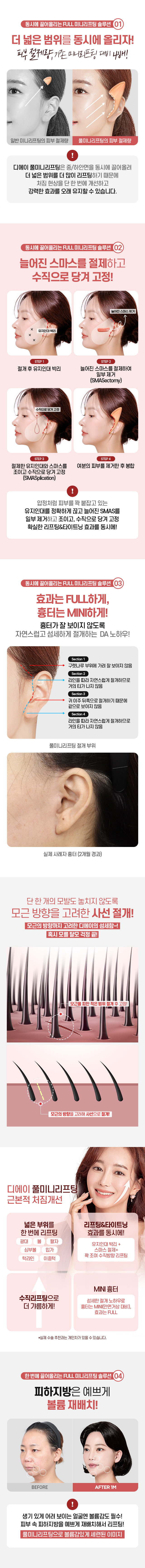 디에이 리프팅 풀미니리프팅