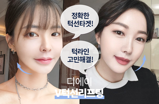 V턱선리프팅 후
