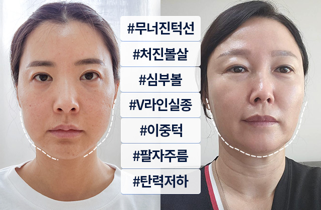 V턱선리프팅 전