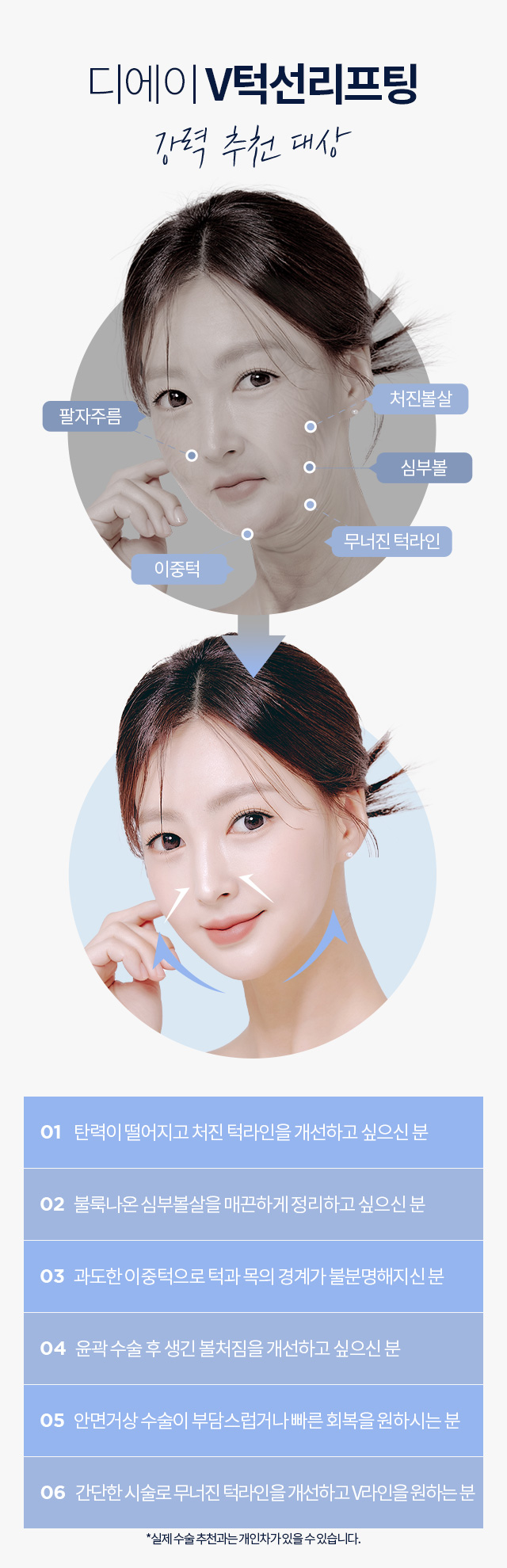 디에이 V턱선리프팅
