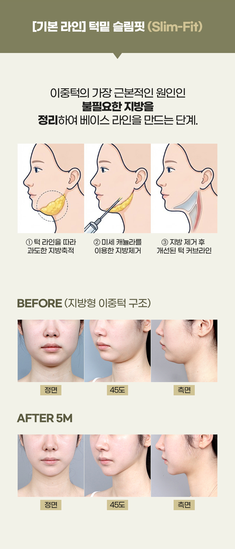 디에이 연조직 이중턱 근육묶기
