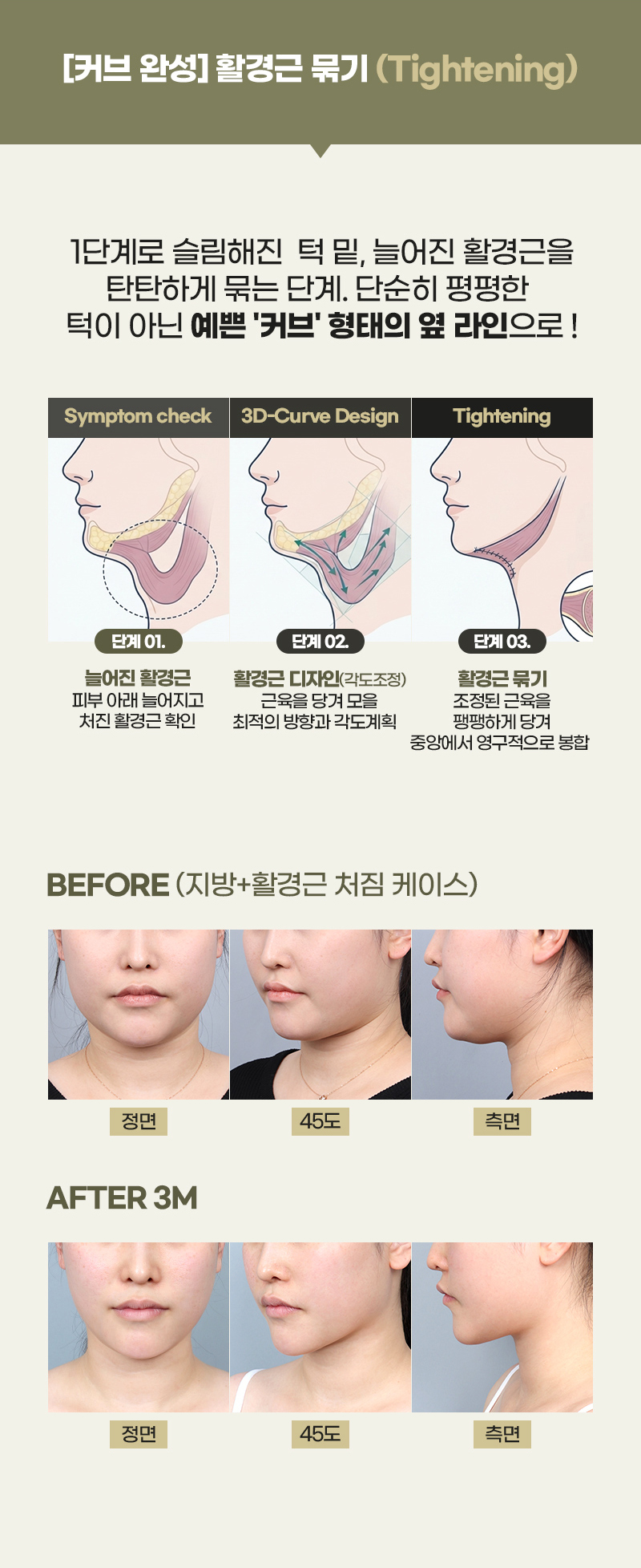 디에이 연조직 이중턱 근육묶기