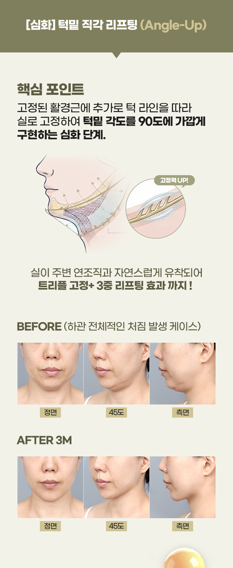 디에이 연조직 이중턱 근육묶기