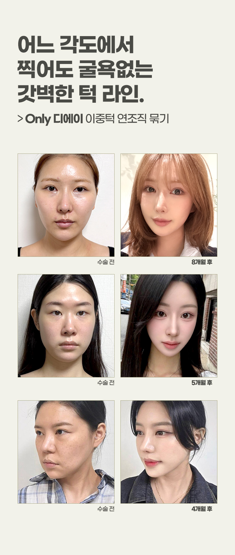 디에이 연조직 이중턱 근육묶기