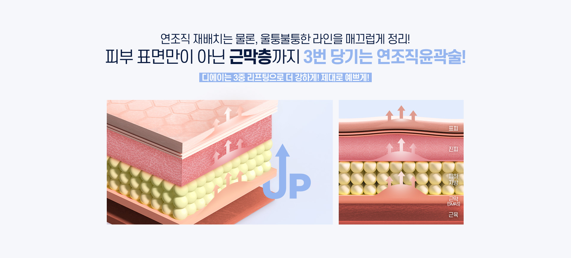 디에이 연조직윤곽술