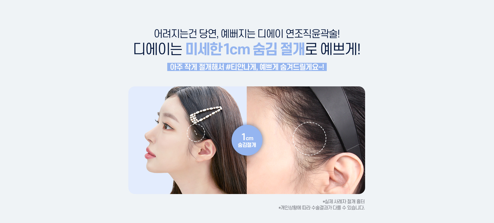 디에이 연조직윤곽술
