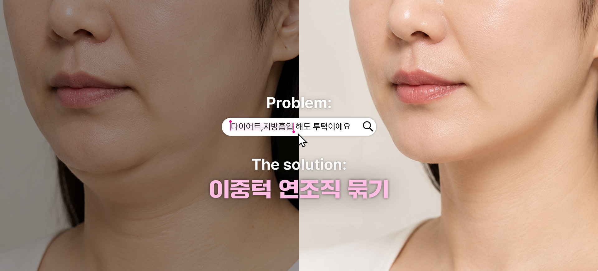 Problem: 다이어트, 지방흡입 해도 투턱이에요 — The solution: 이중턱 연조직 묶기