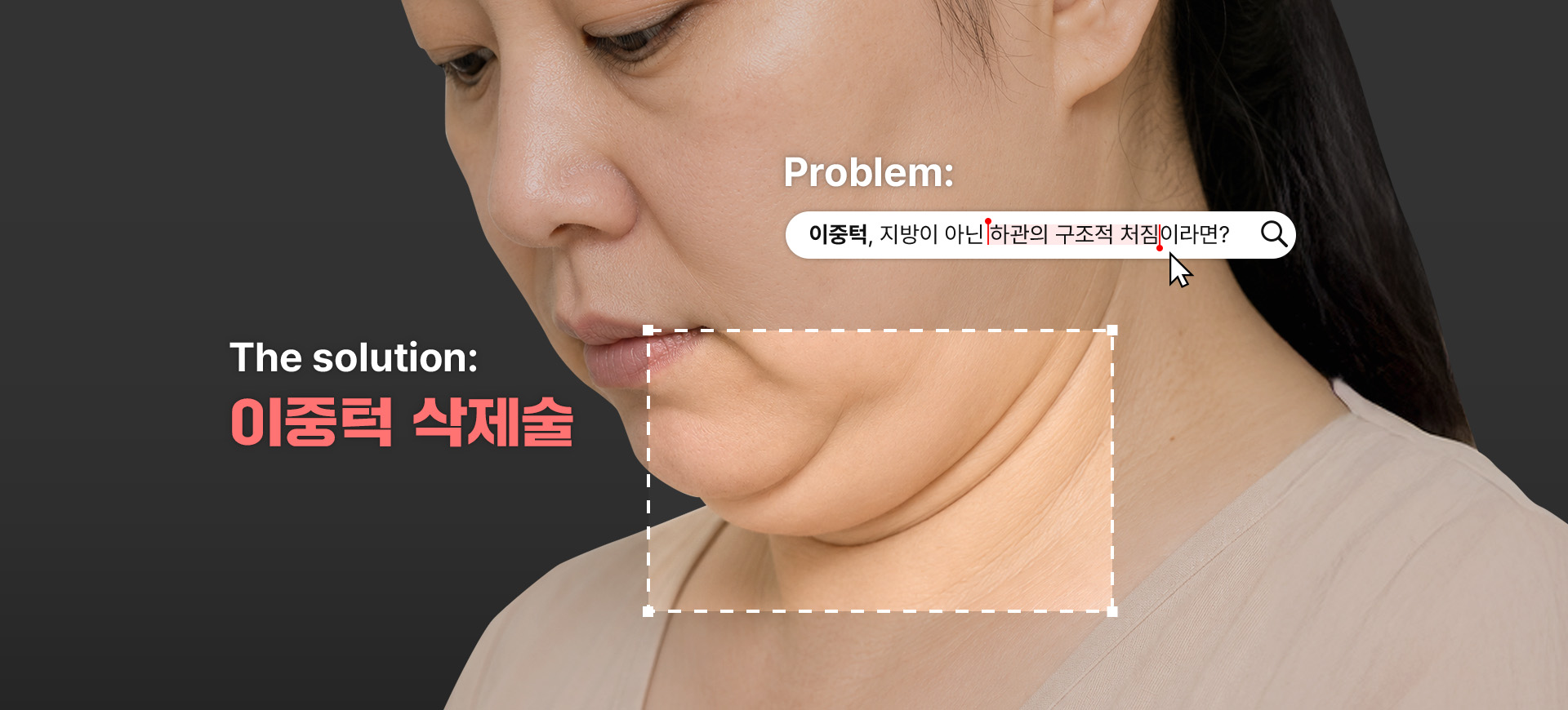 Problem: 이중턱, 지방이 아닌 하관의 구조적 처짐이라면? — The solution: 이중턱 삭제술