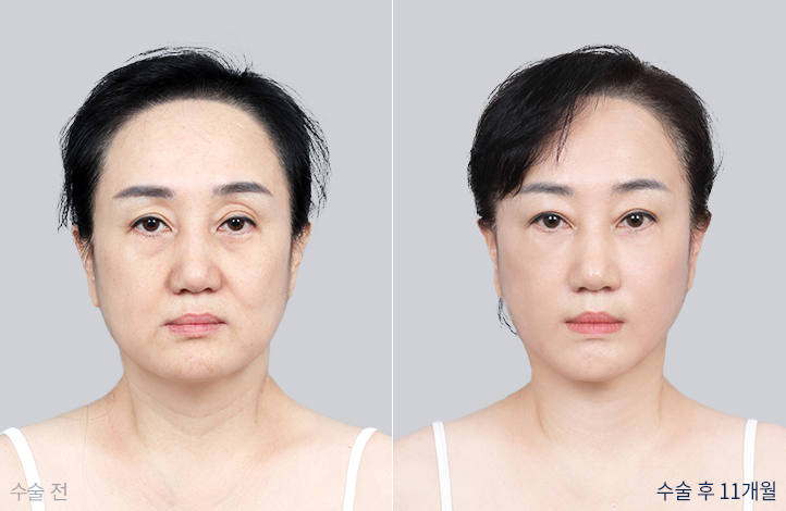 전후사진